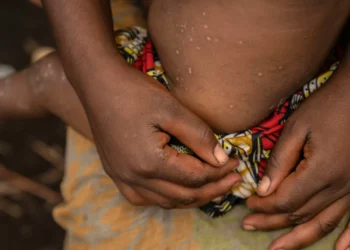 Mpox. Casos em crianças multiplicaram-se por 75 em província congolesa