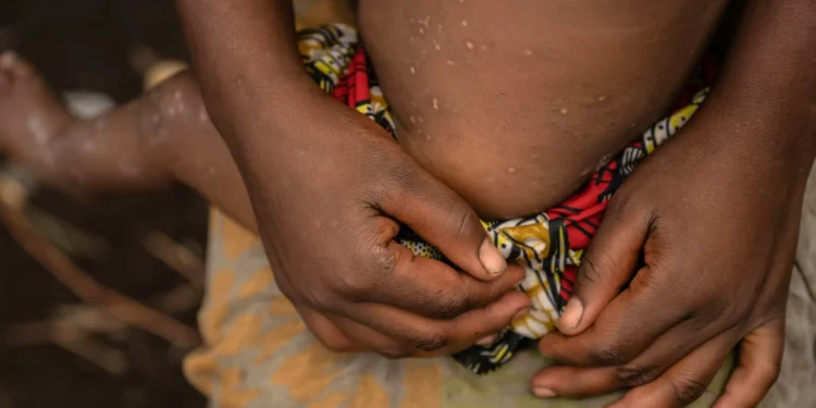 Mpox. Casos em crianças multiplicaram-se por 75 em província congolesa