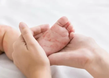 Mais um estado em alerta. Michigan com surto de sarampo (1.º desde 2019)